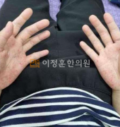 치료전