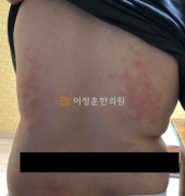 치료전