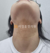 치료전